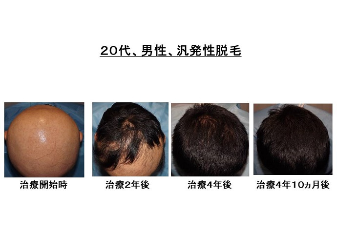円形脱毛症　病院""